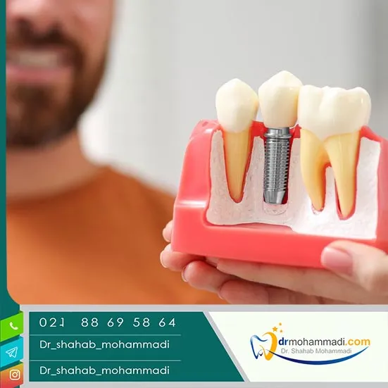 راهکارهای پرداخت اقساطی یا بیمه برای کاهش هزینه ایمپلنت